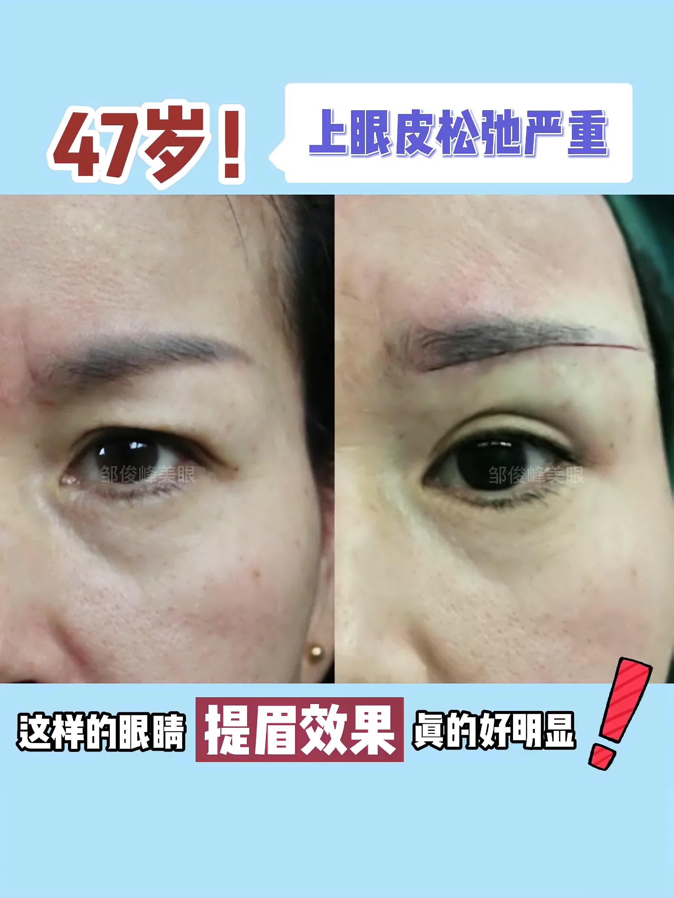 47岁上眼睑松弛严重提眉术后效果是这样的