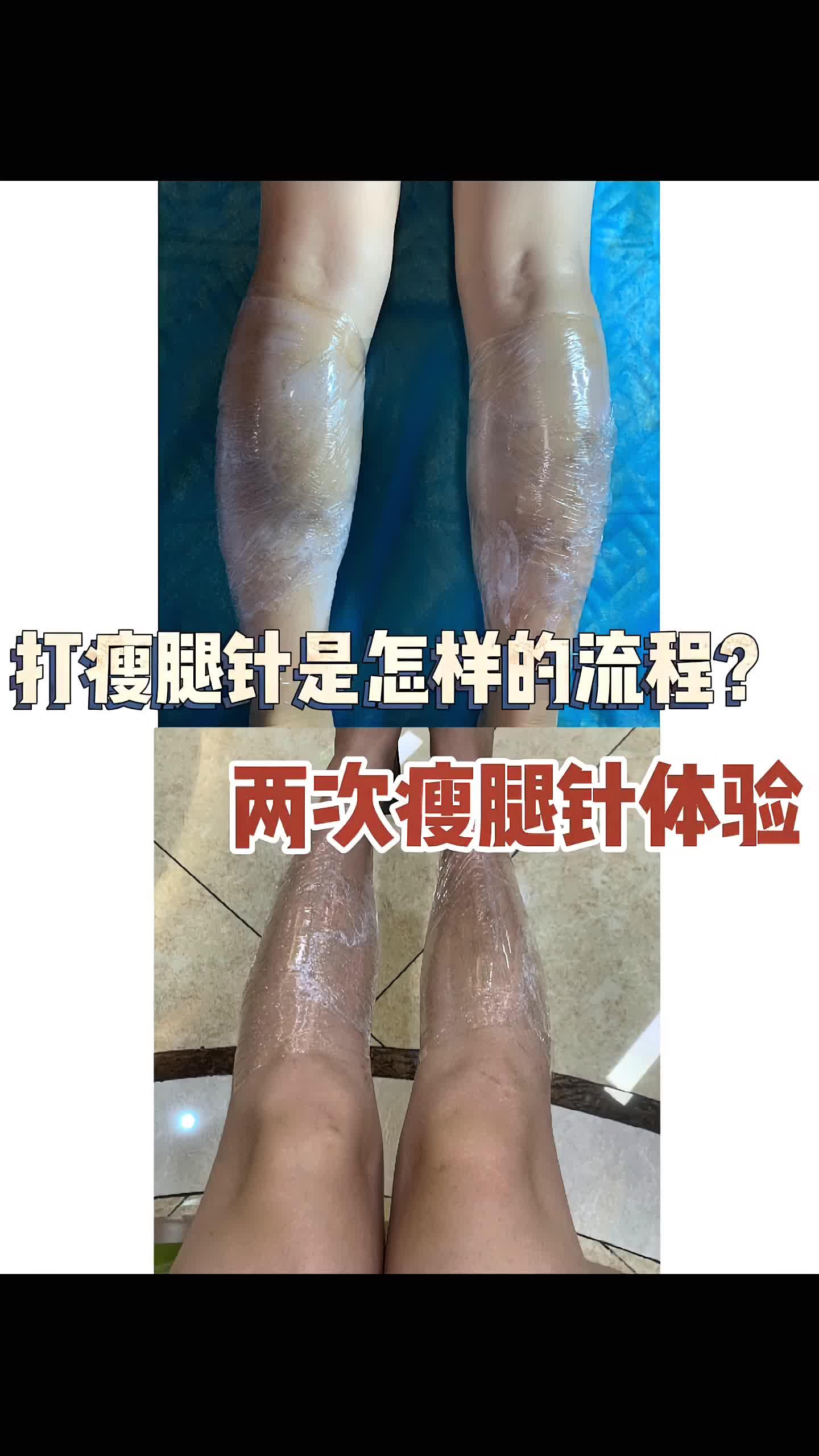 瘦腿针布点图图片