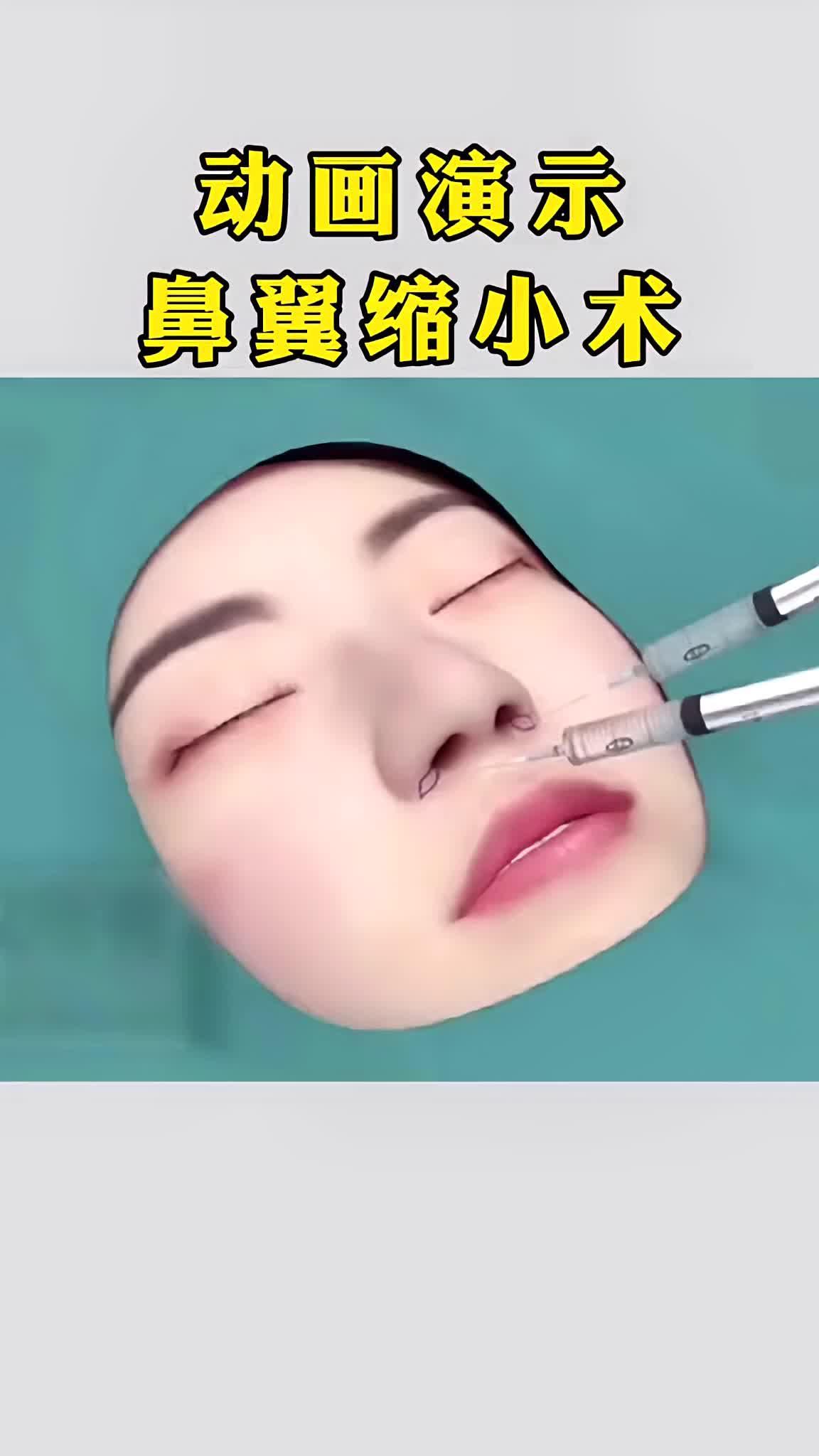 看一看鼻翼缩小术的过程