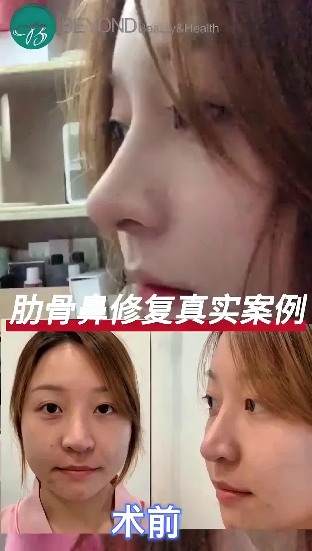 术前鼻尖下旋明显,之前做过膨体 耳软骨垫鼻尖,需取_圈子-新氧美容