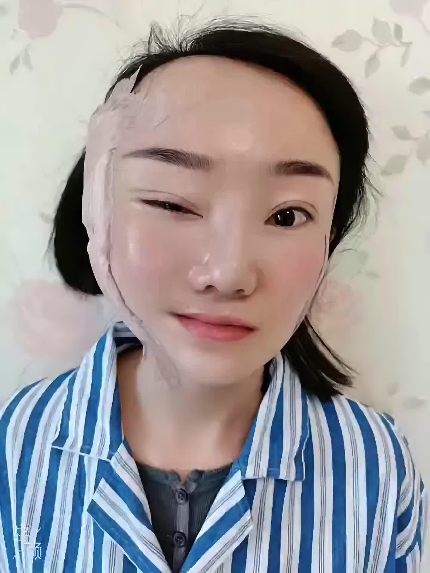 五层筋膜提升拉皮一侧即可效果_圈子-新氧美容整形
