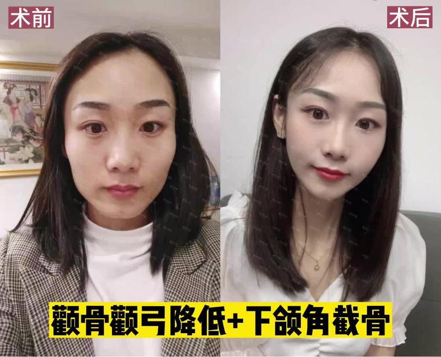 小娜娜整容图片