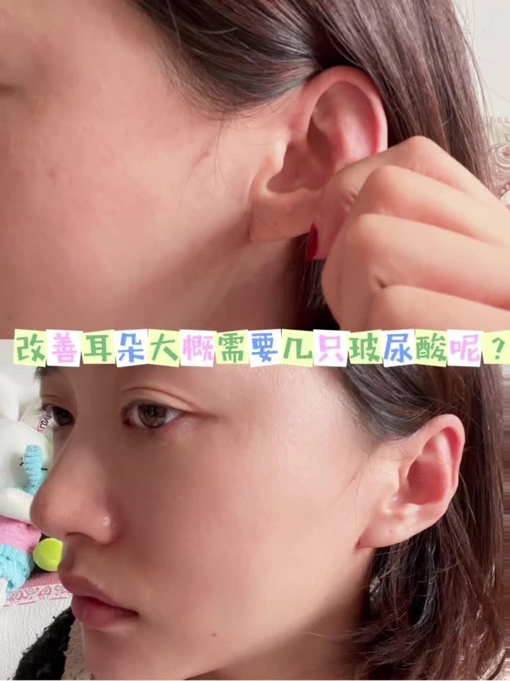 玻尿酸改善耳朵到底该怎么做
