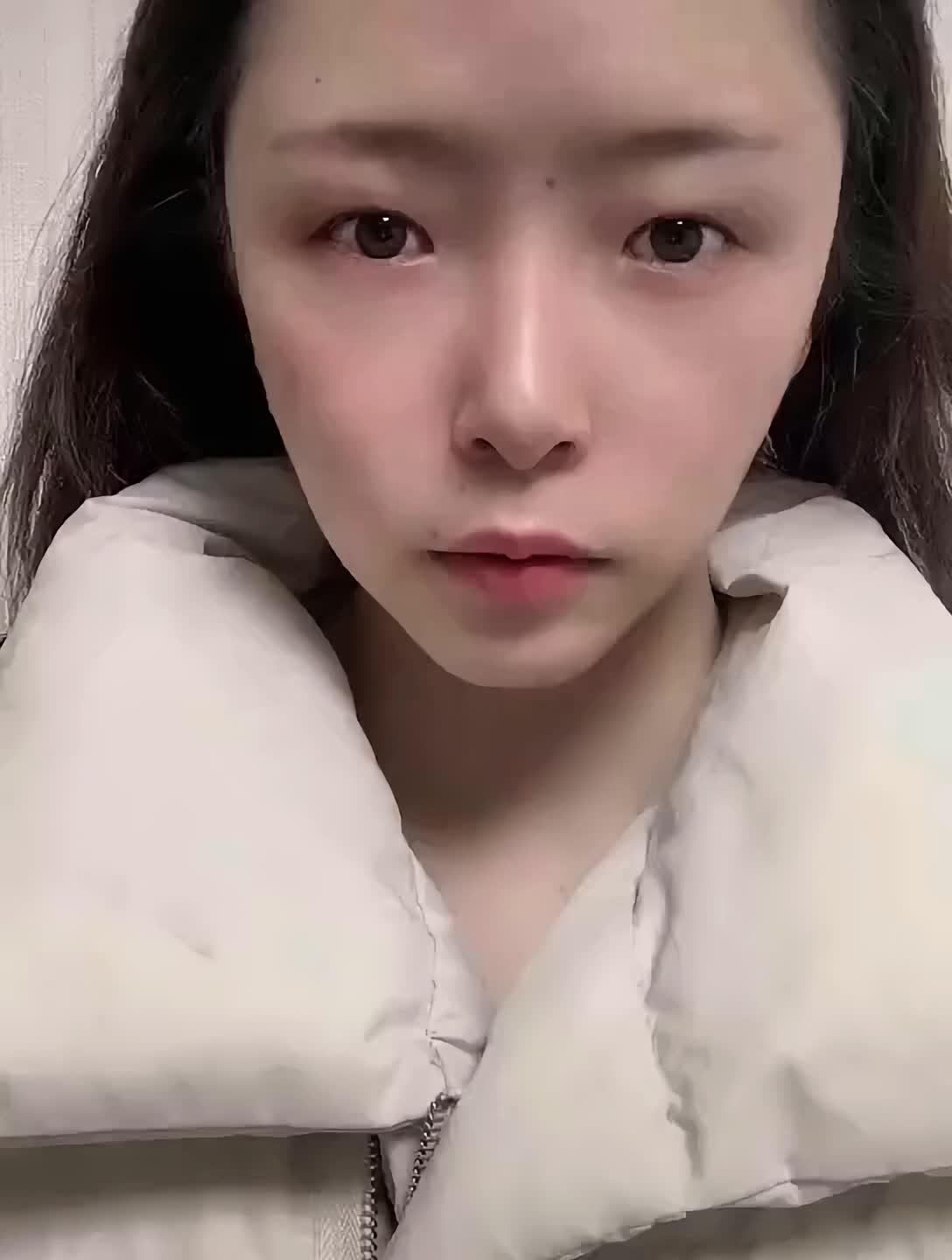 术前眼裂短无神,双眼皮术后眼睛灵动有神#做的双眼皮_圈子-新氧美容