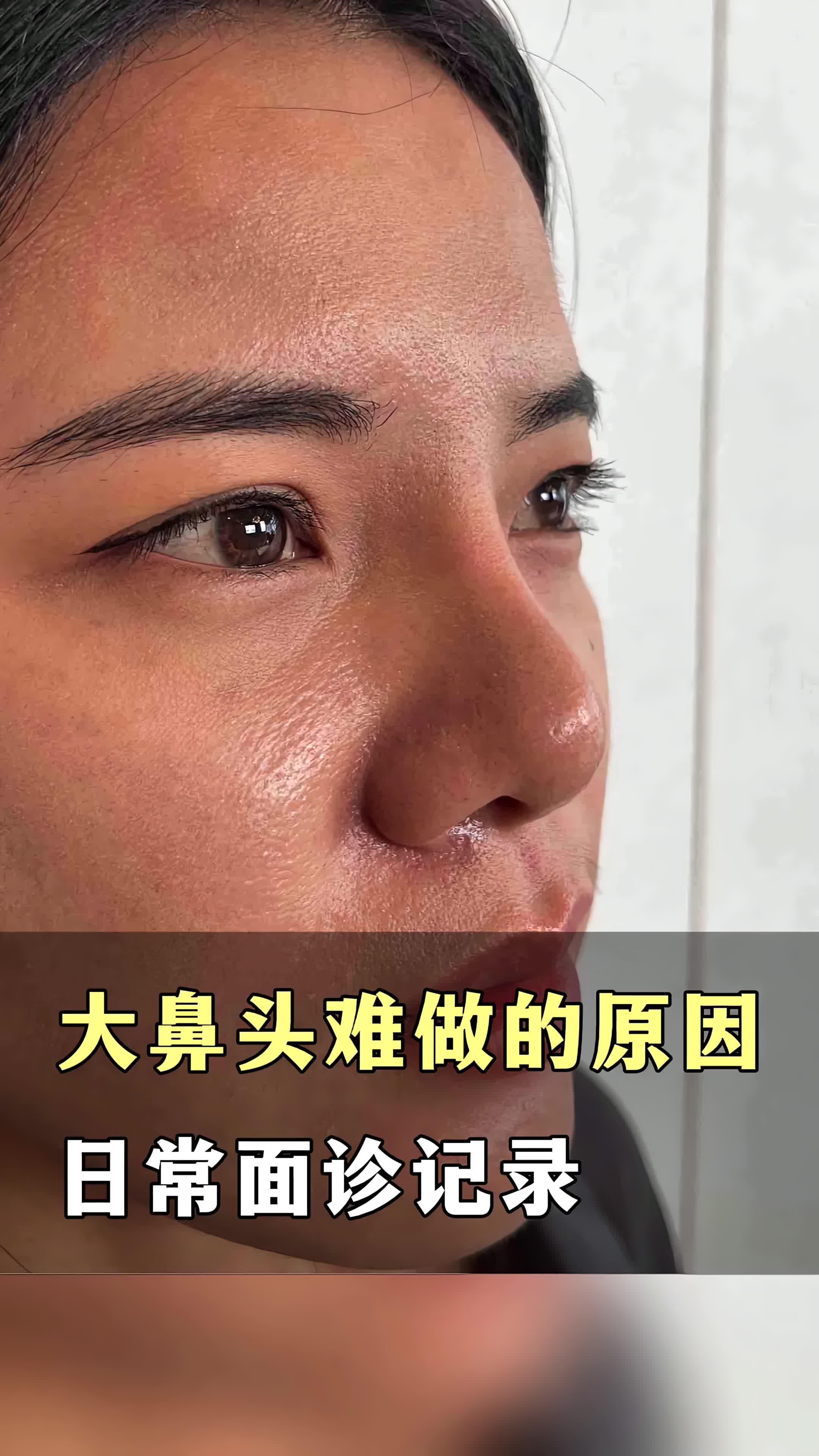 瘦脸轮廓 方案 手术缩鼻头 手术 轻度疼痛 1-3个月左右恢复 鼻头缩小