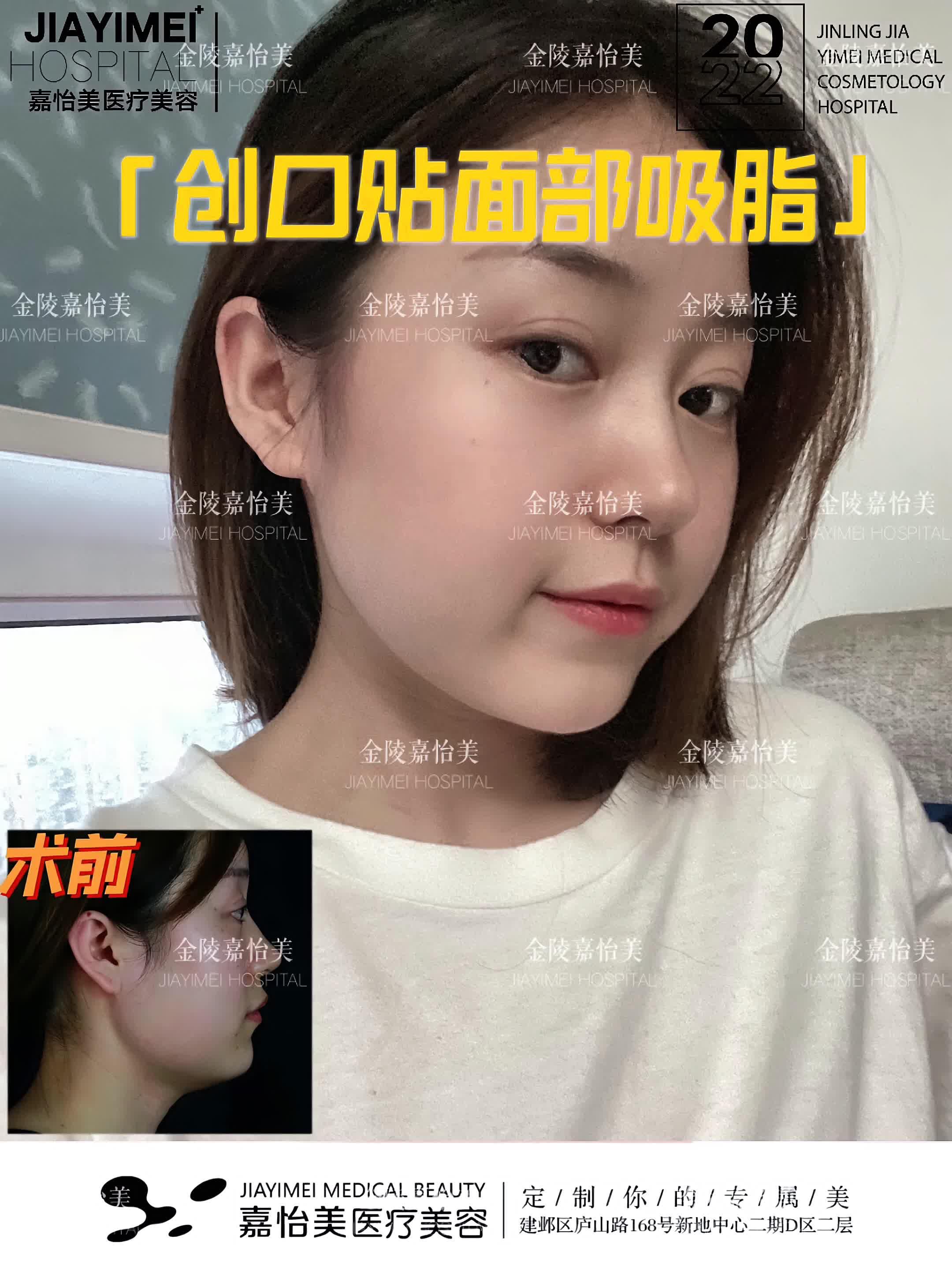 15术前中下面部脂肪堆积,颊脂垫肥大,下颌松弛下垂面_圈子-新氧美容