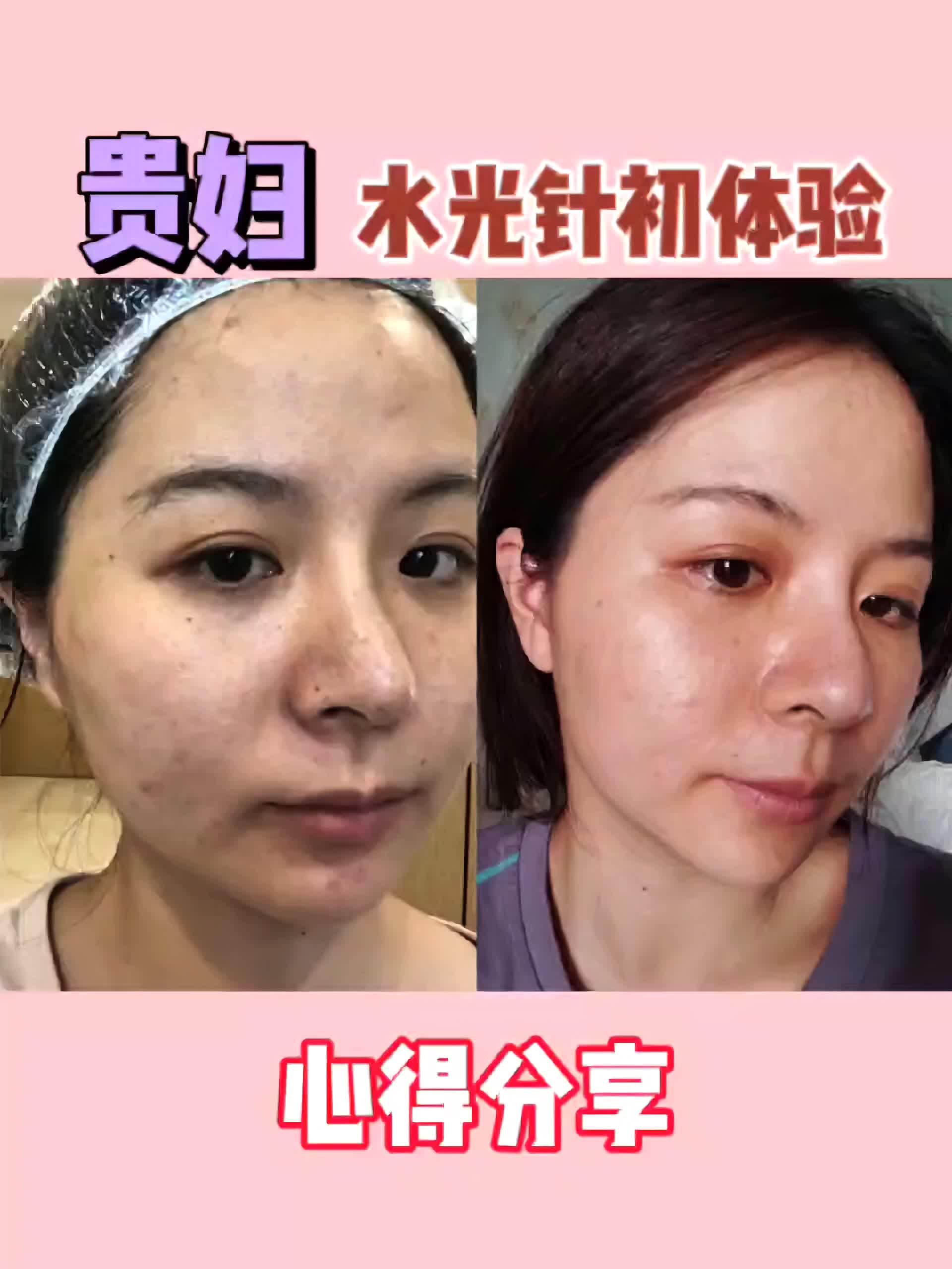 第二天的變化究竟如何呢?#新氧體驗官潤娜塔童顏水凝