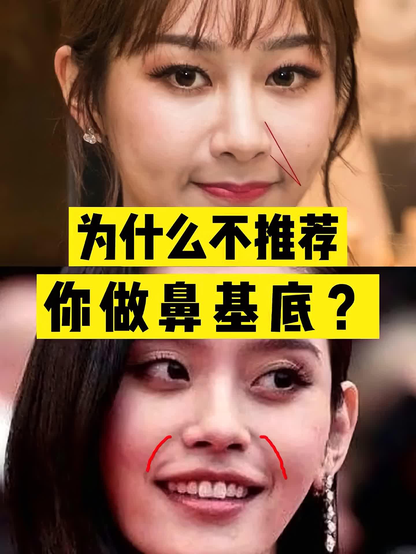 垫了鼻基底反而更丑了71你真的适合吗71填充鼻基底大家_圈子-新氧