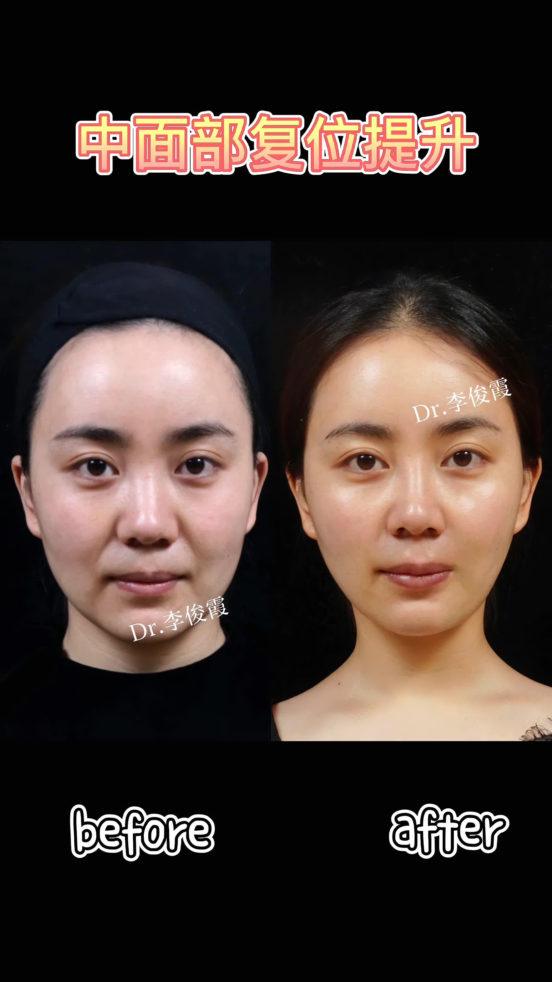 杭州艺星气质微整形中面部复位提升