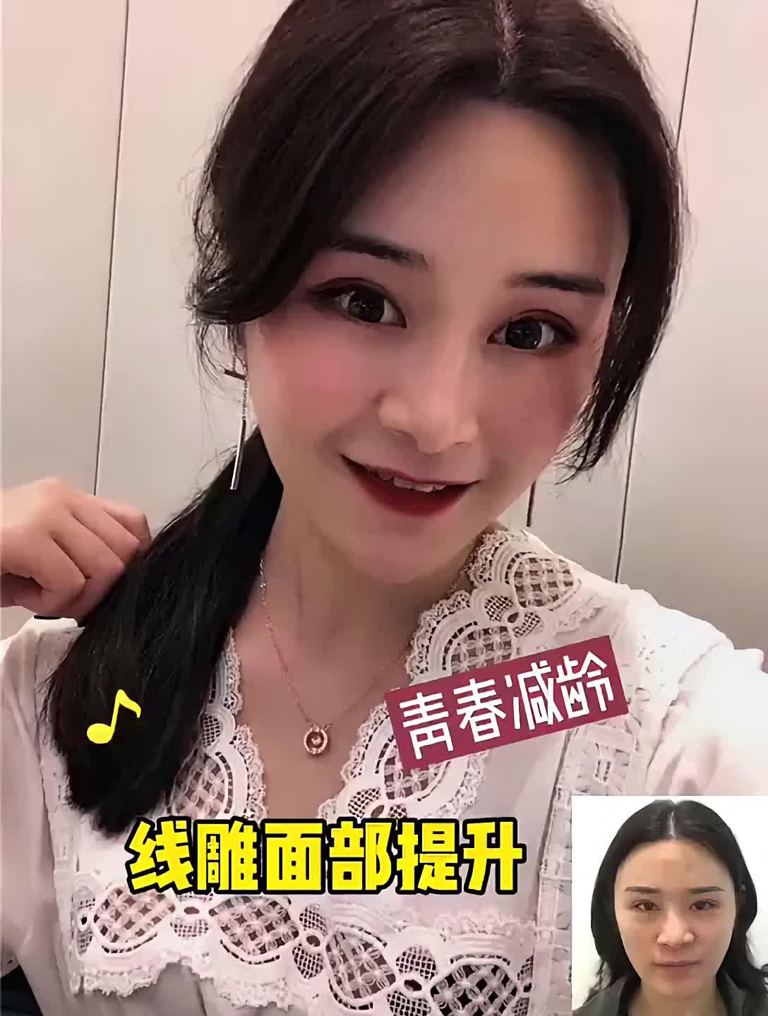 线雕面部提升!v脸呈现!整张脸变小很多,现在整个面_圈子-新氧美容整形