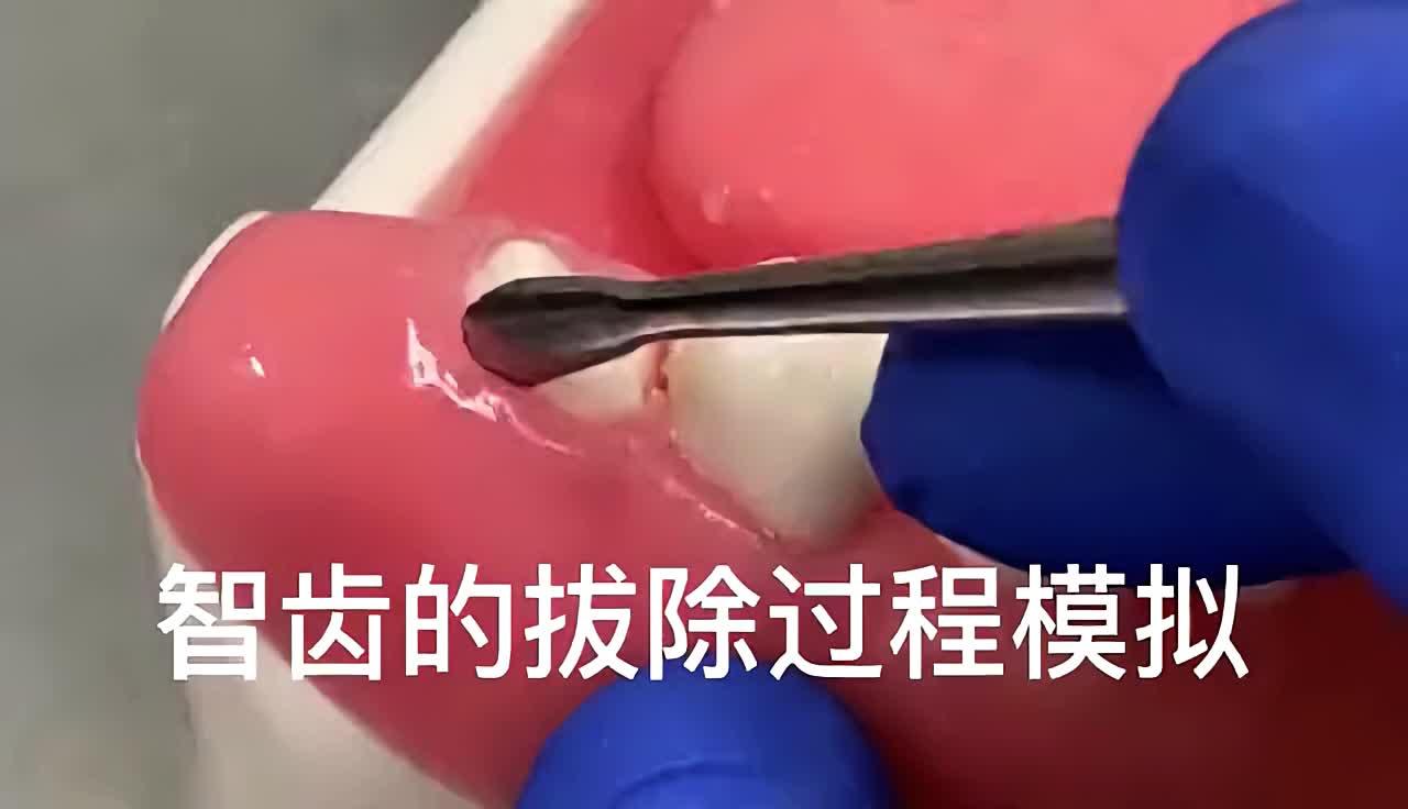 埋伏智齿拔除过程模拟,看看你的智齿是不是这样拔的?